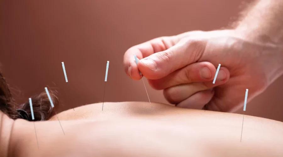 Les bienfaits de l&rsquo;Acupuncture